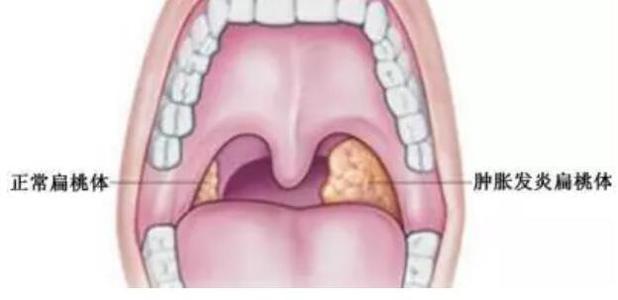 扁桃体炎的症状有哪些表现