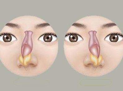 鼻中隔偏曲的症状表现有哪些