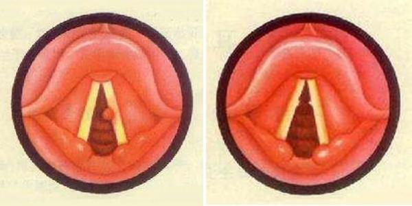 咽喉出现小疙瘩是怎么回事？