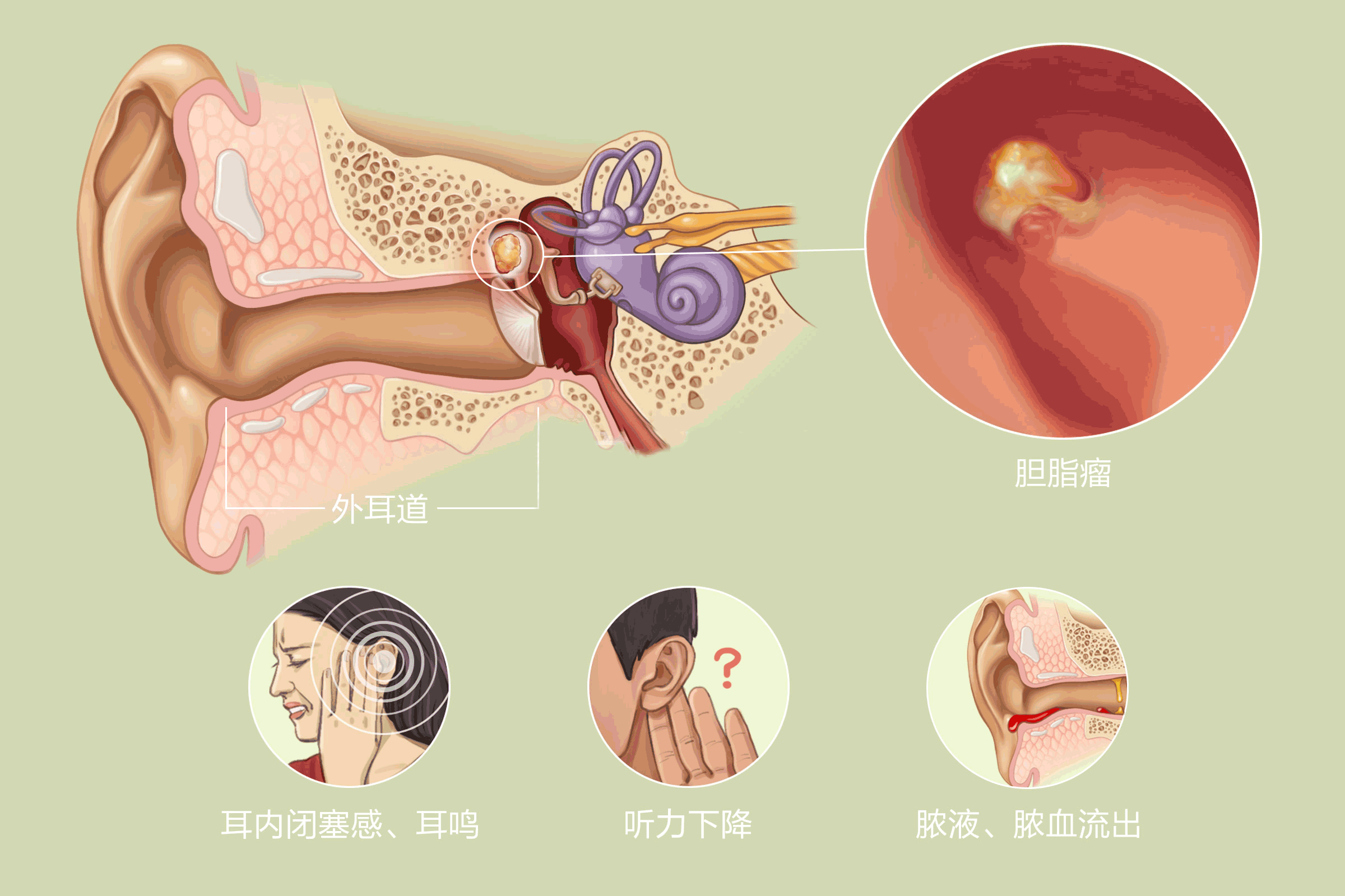 胆脂瘤型中耳炎