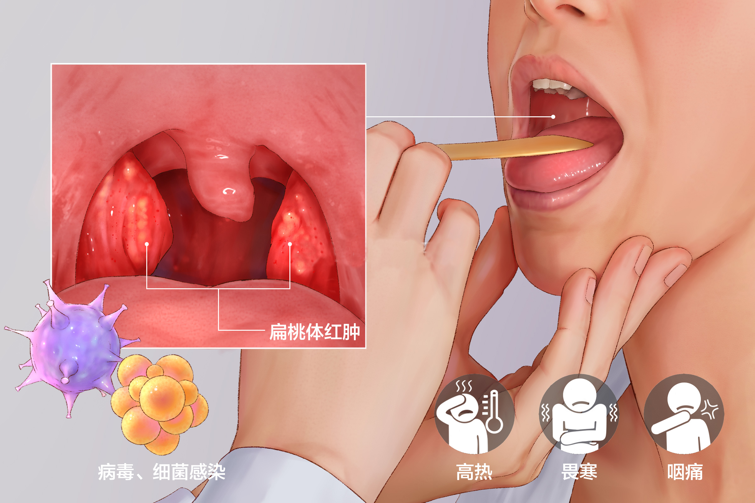 重庆治疗扁桃体炎医院